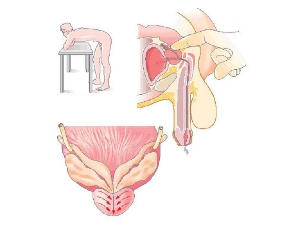 Prostate massage technique used by the doctor to analyze secretions